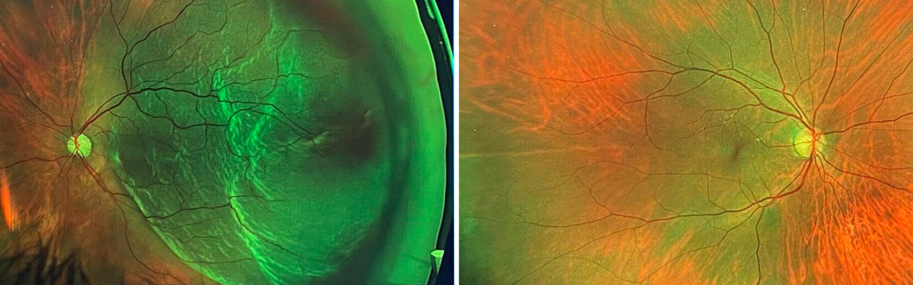 Eye scan showing retinal detachment in left eye vs patient's healthy right eye.